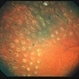 Proliferative Diabetic Retinopathy (PDR), PRP, Regressed NV